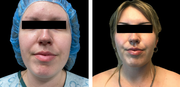 Lower Face Liposuction 01