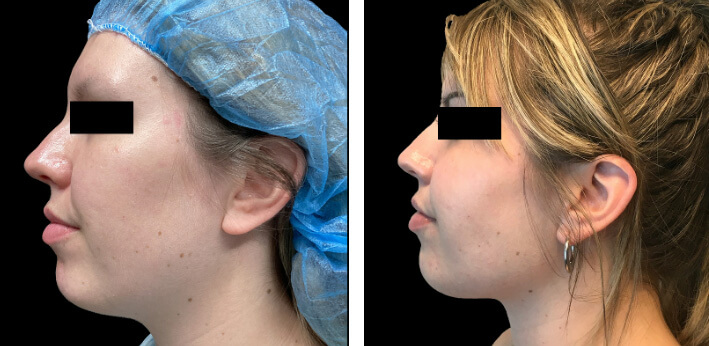 Lower Face Liposuction 02