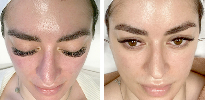 Microneedling Before After 01