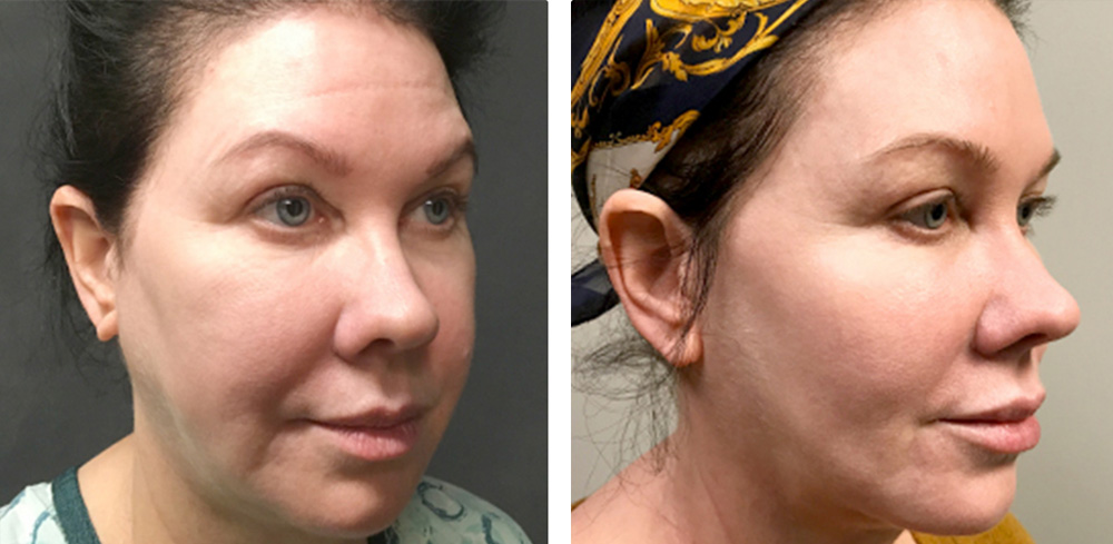 Mid Facelift Before After 02