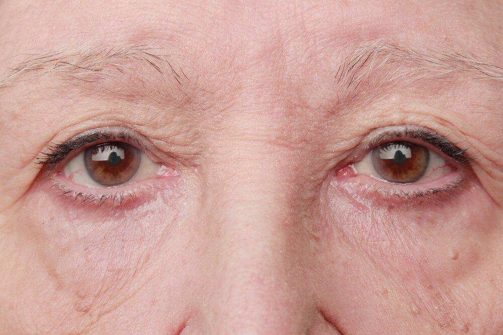 The Benefits Of Hooded Eye Botox In Seattle