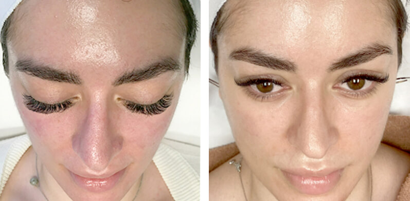 Chemical Peels Before After