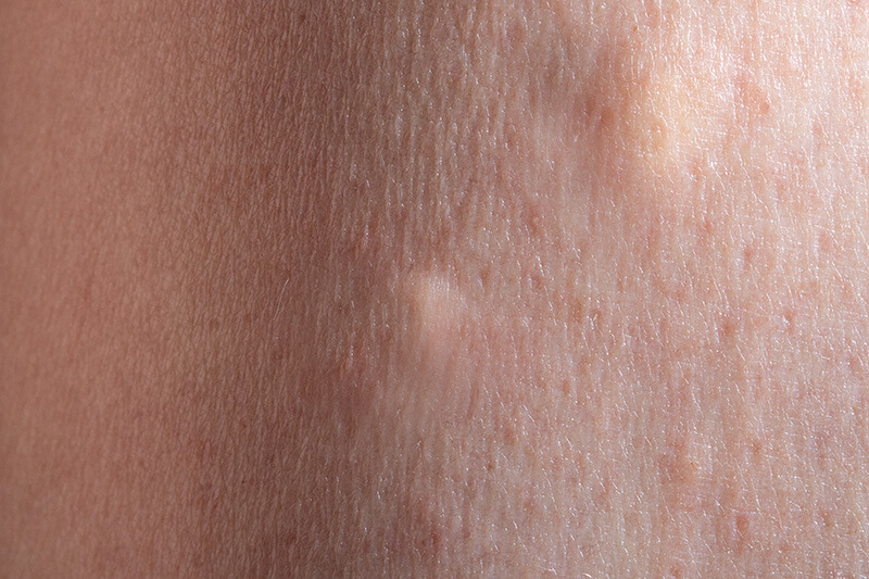 Dissolving Sculptra Nodules 02