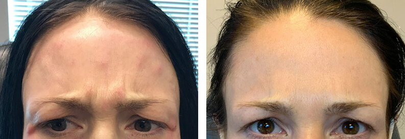 Dysport Before After 02