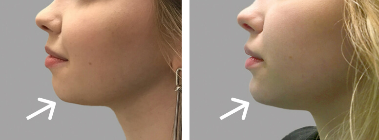 Facial Filler Jawline Before After