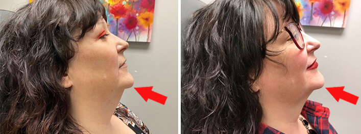 Kybella Before After