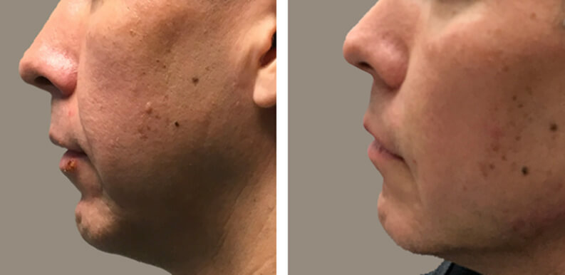 Non Surgical Jawline Enhancement Before After 01