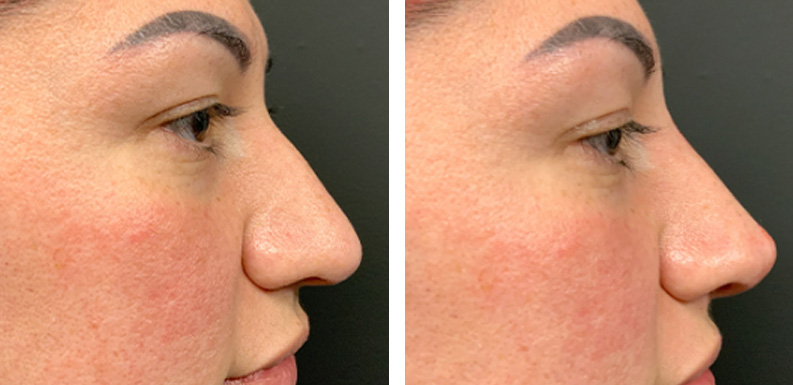 Non Surgical Rhinoplasty Before After 02