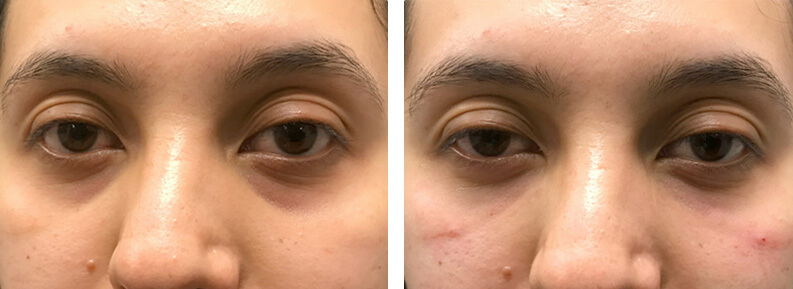 Under Eye Filler Before After