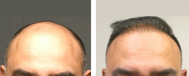 Hair Transplant Before After 02