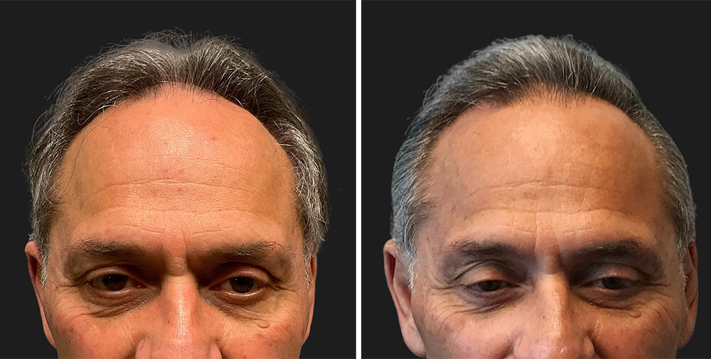 Hair Transplant 022
