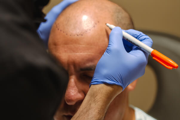 Hair Transplant Revision 03