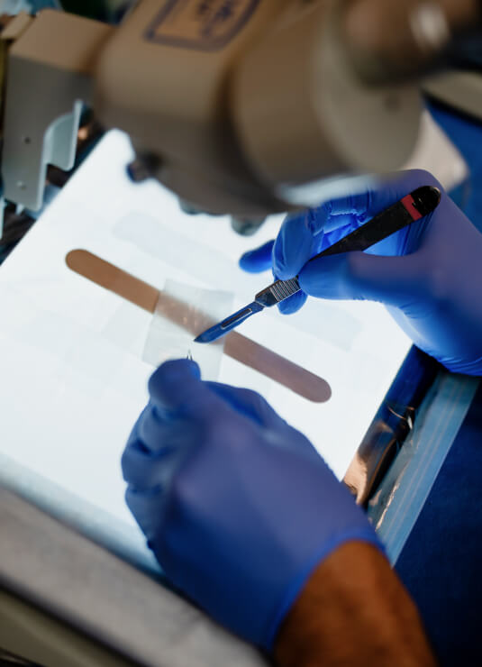 Hair Transplant Revision 04