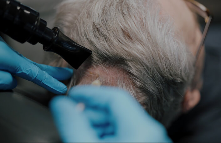 Non Surgical Hair Restoration 03