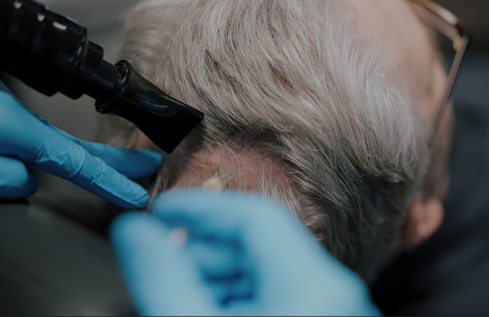 Non Surgical Hair Restoration 05