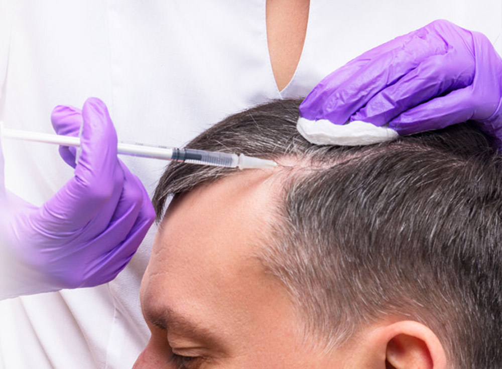 Prp Hair Treatment