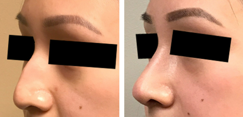Ethnic Rhinoplasty Before After 02