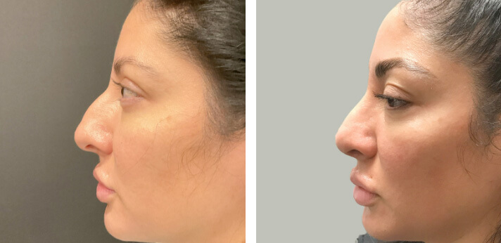 Rhinoplasty Revision 003