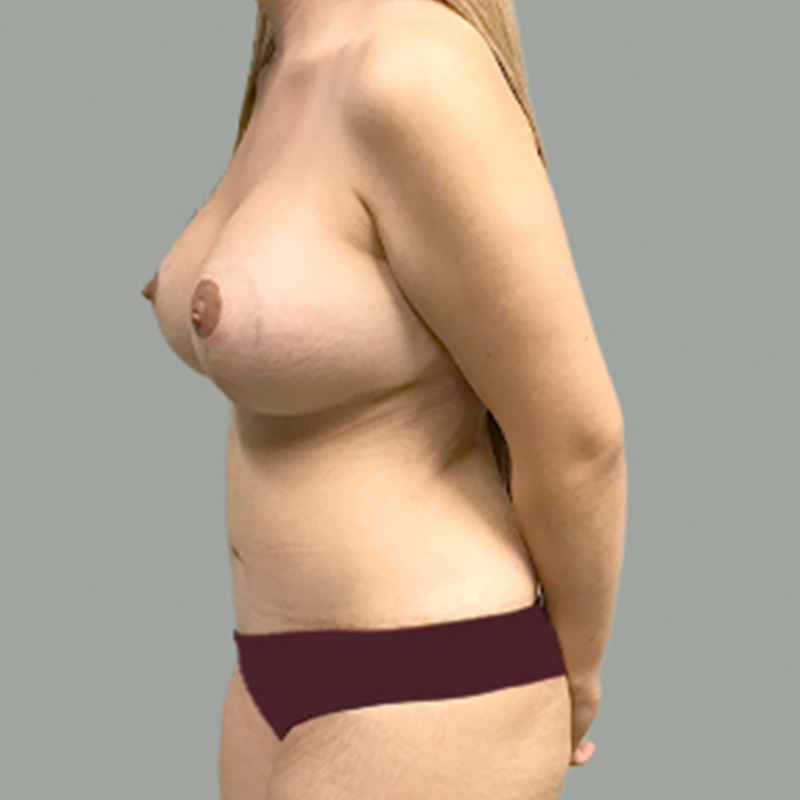 Abdominoplasty 09
