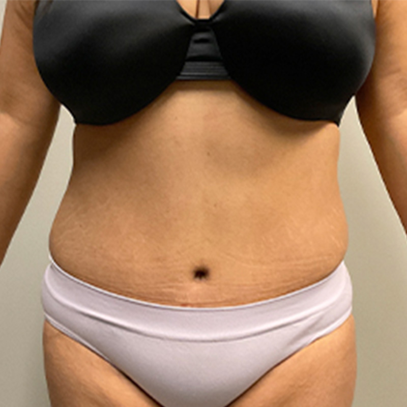 Abdominoplasty 03