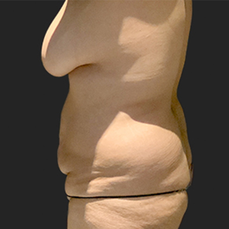 Abdominoplasty 05