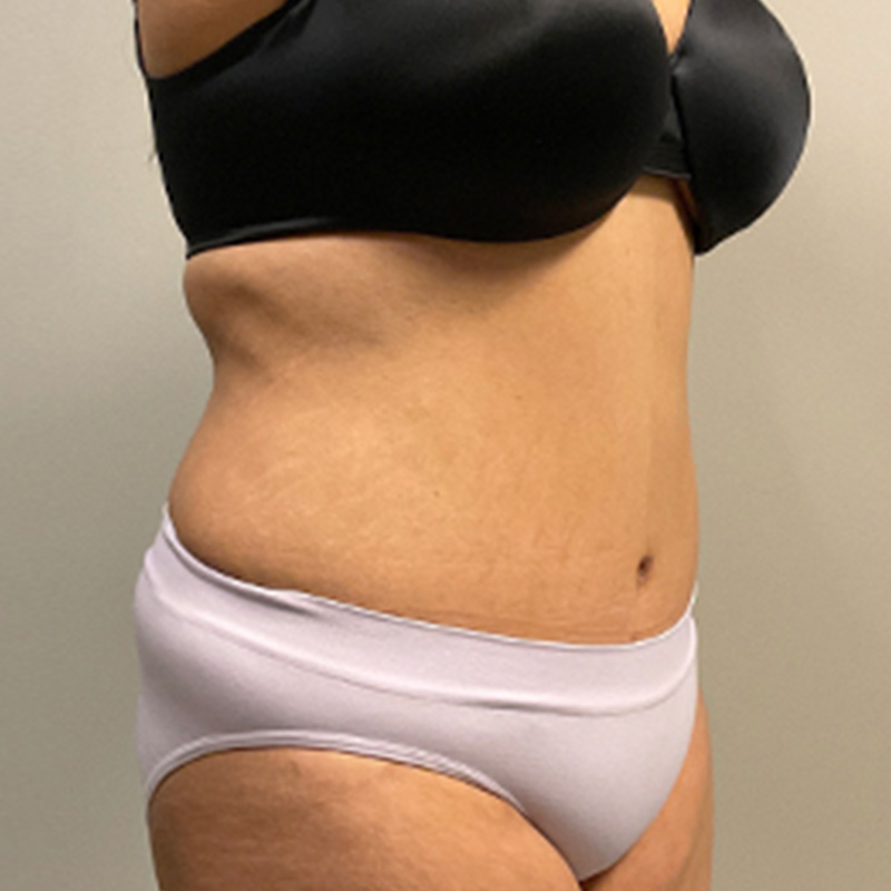 Abdominoplasty 07