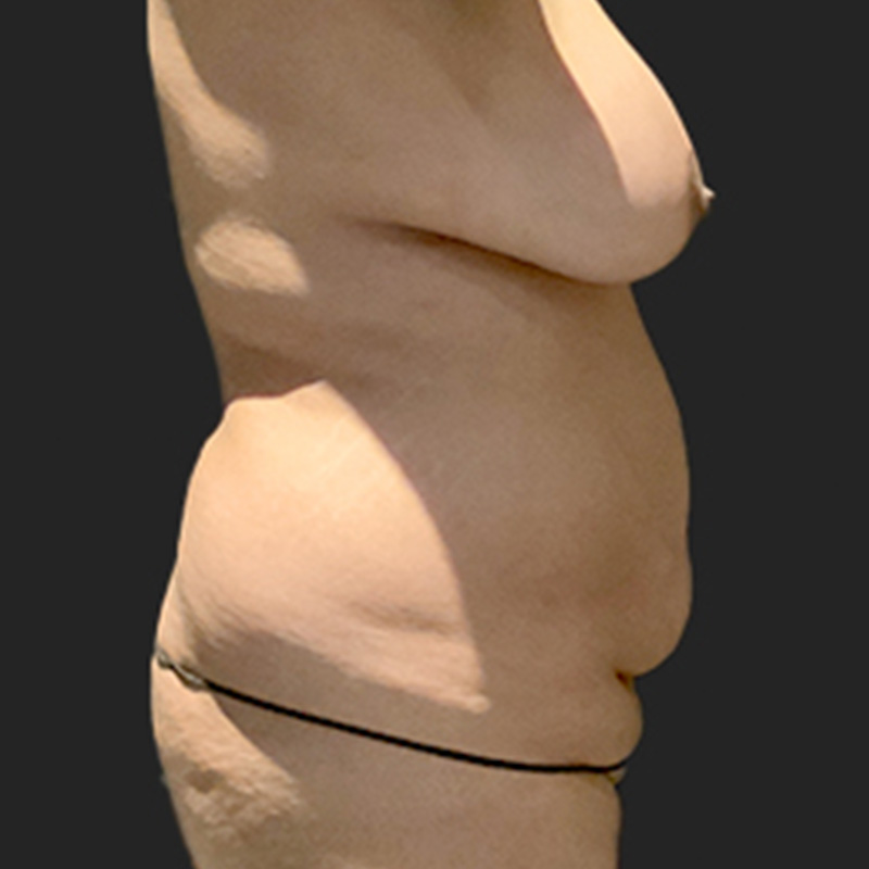 Abdominoplasty 09