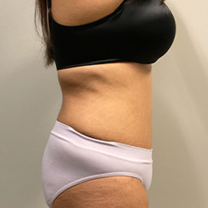 Abdominoplasty 09