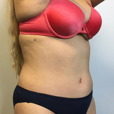 Abdominoplasty 03