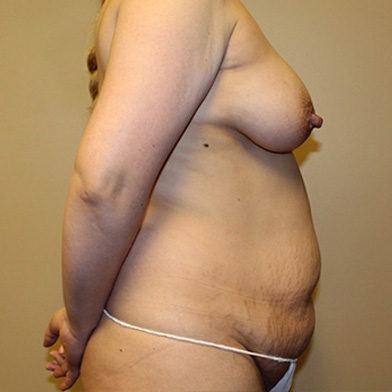 Abdominoplasty 05