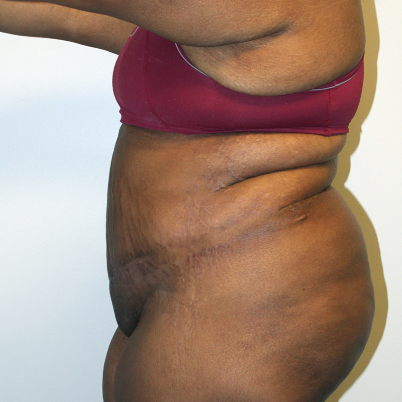 Abdominoplasty 07