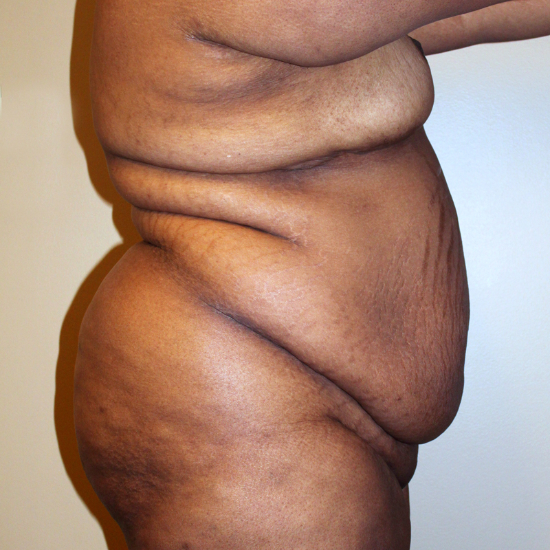 Abdominoplasty 03