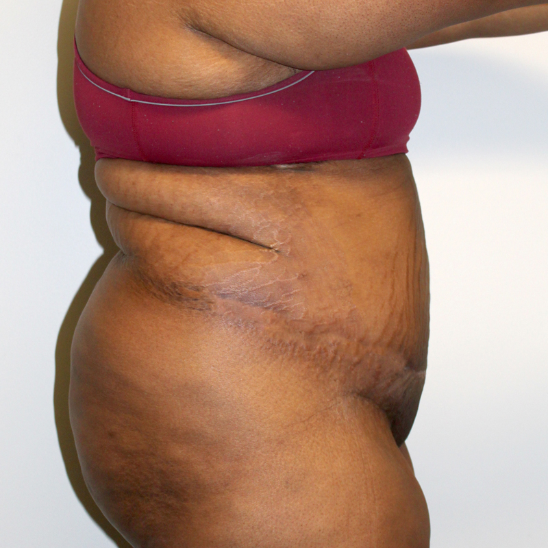 Abdominoplasty 03
