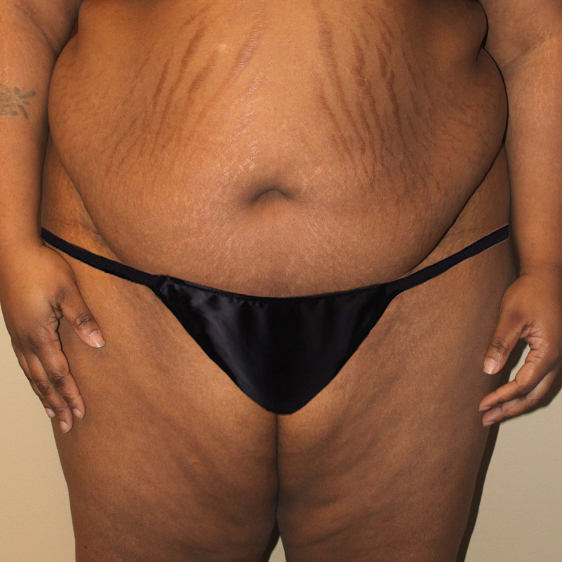 Abdominoplasty 05