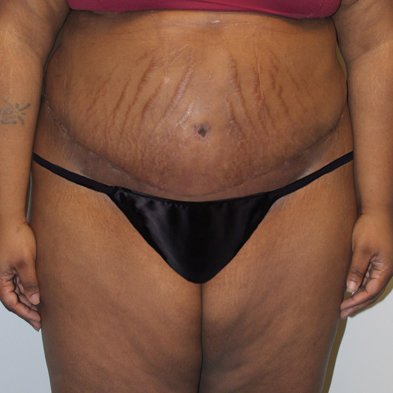 Abdominoplasty 05