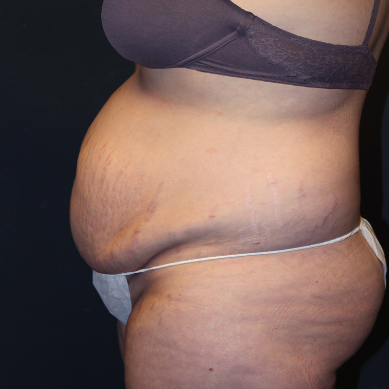 Abdominoplasty 03