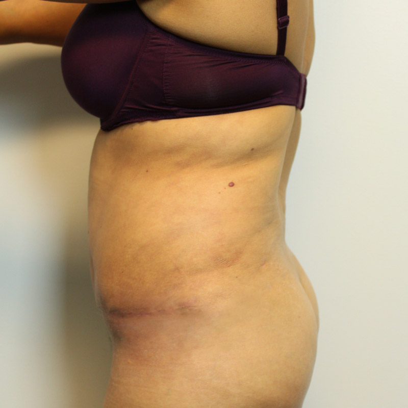 Abdominoplasty 03