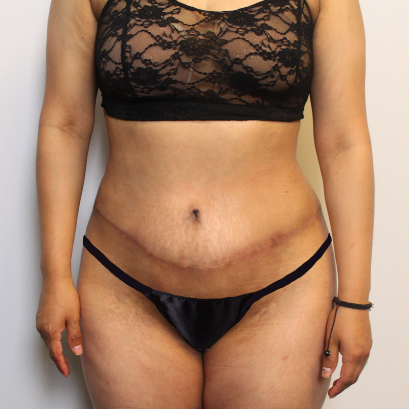 Abdominoplasty 11