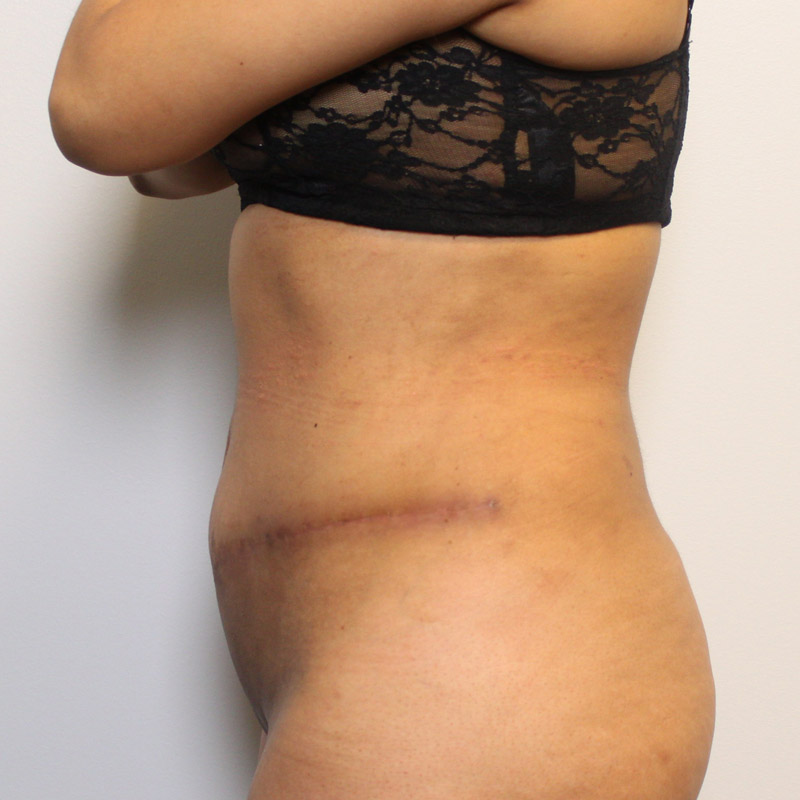 Abdominoplasty 03