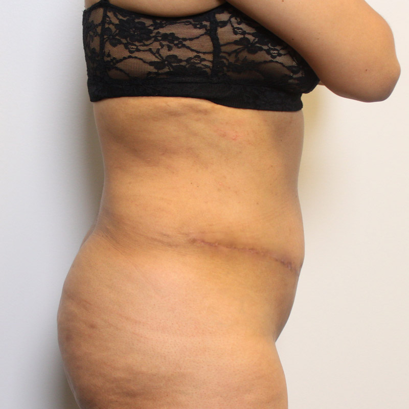 Abdominoplasty 05