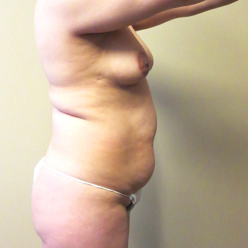 Abdominoplasty 05