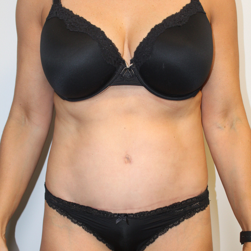 Abdominoplasty 13