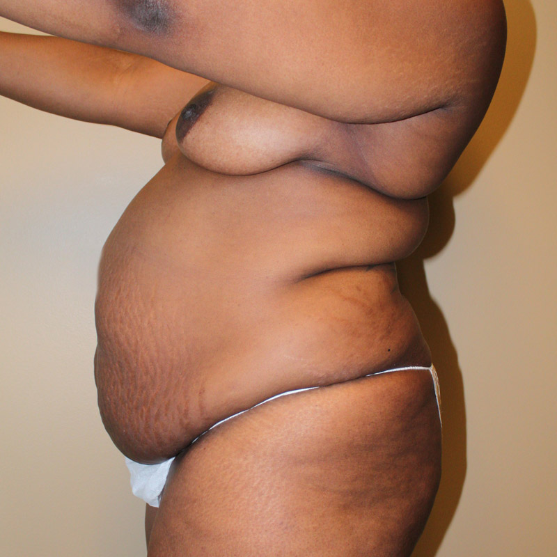 Abdominoplasty 03