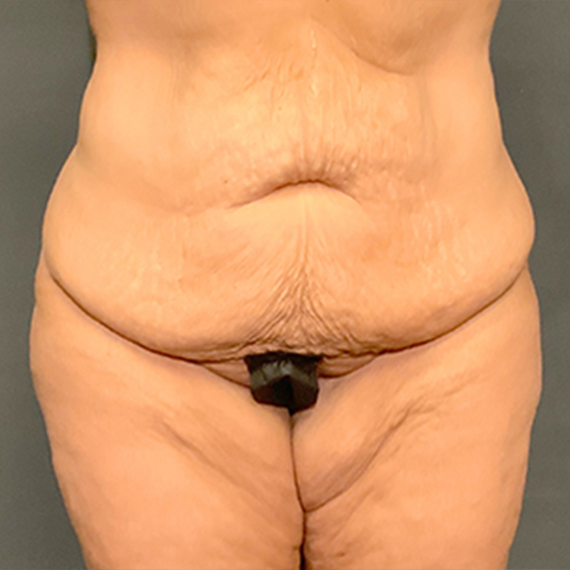 Abdominoplasty 01