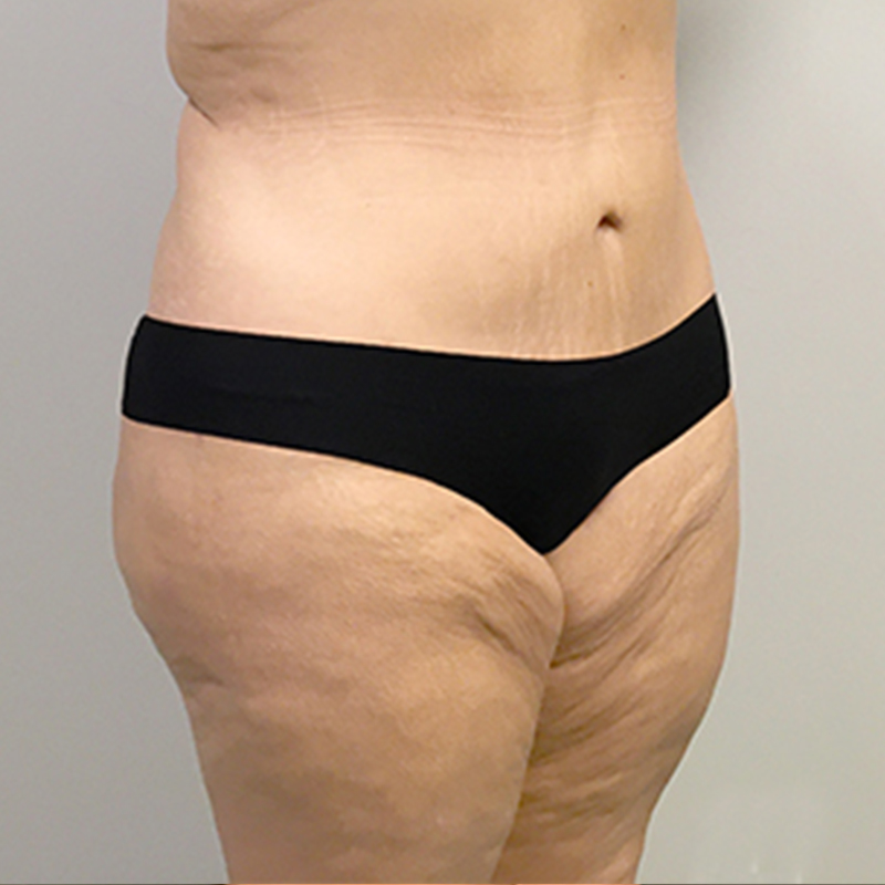 Abdominoplasty 03