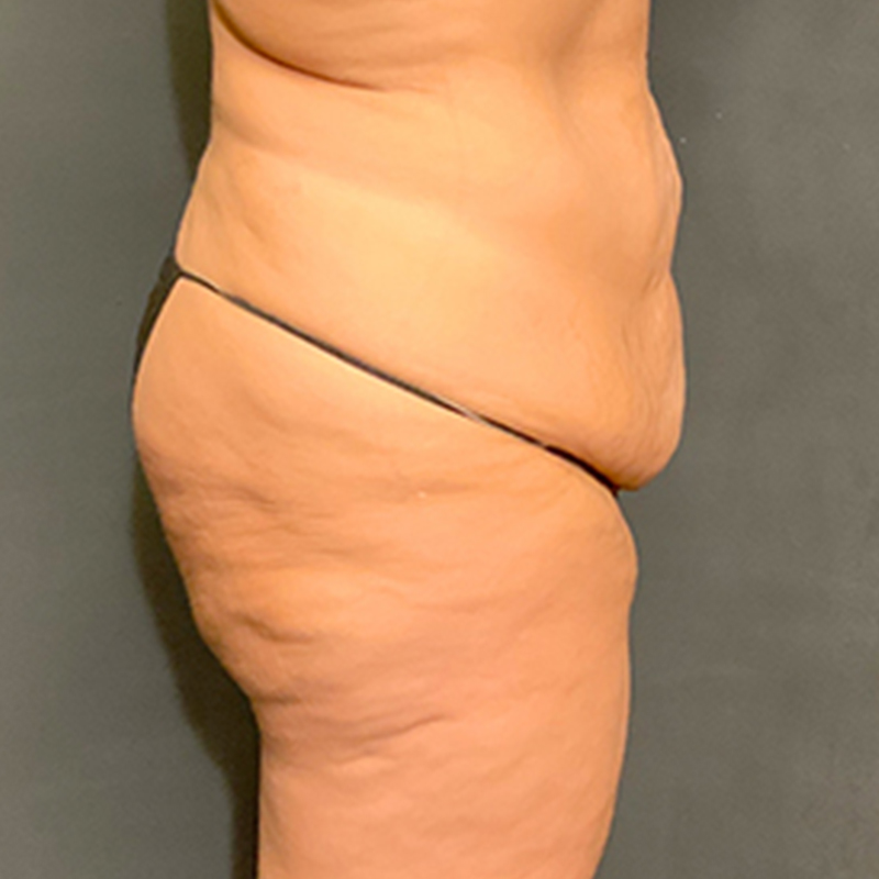 Abdominoplasty 05