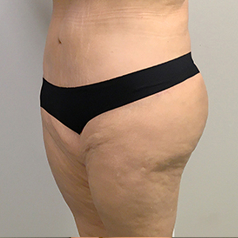 Abdominoplasty 07