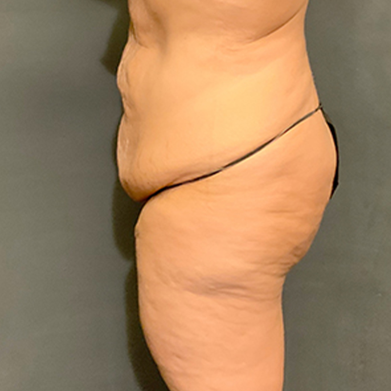 Abdominoplasty 09