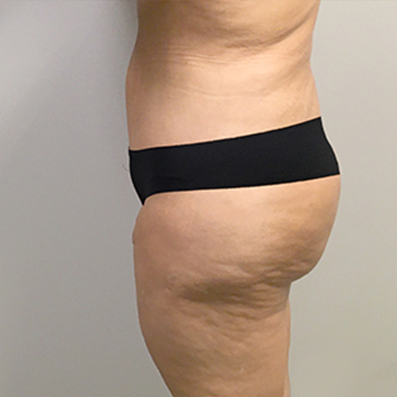 Abdominoplasty 09