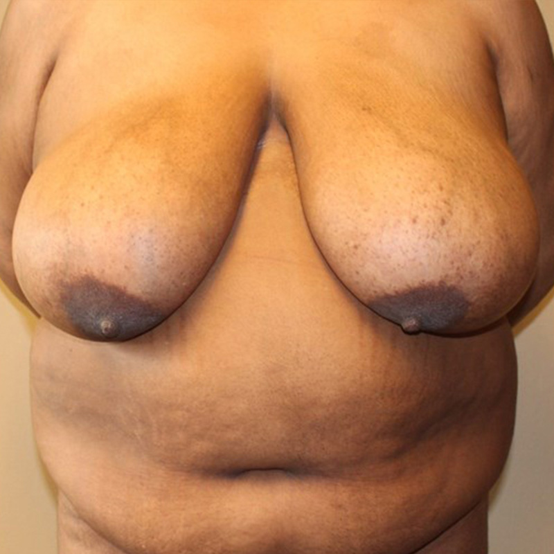 Abdominoplasty 01